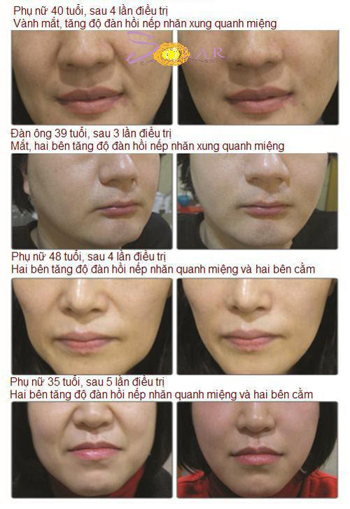 Solar Spa, Căng da trẻ hóa, Căng da trẻ hóa công nghệ cao, Thẩm mỹ viện Căng da trẻ hóa