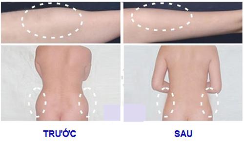 Giảm mỡ bụng, Giảm mỡ bụng công nghệ cao, Giảm mỡ bụng không phẫu thuật, Solar spa