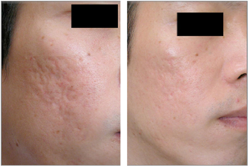 Solar Spa, Xóa sẹo lõm, Xóa sẹo lõm công nghệ cao