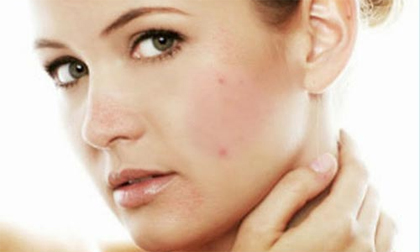 lòng trắng trứng, da mặt, dị ứng da, chữa dị ứng da mặt