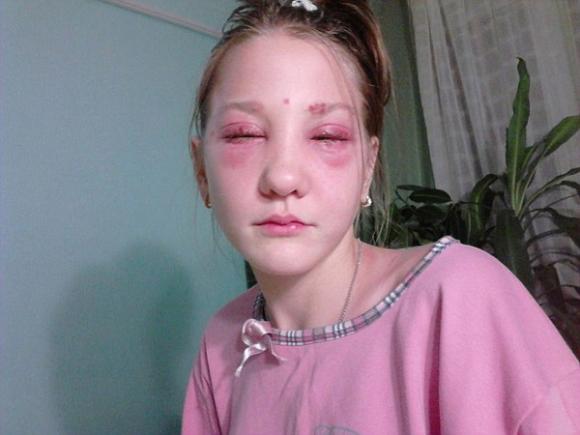 nữ sinh 13 tuổi suýt bị mù vì nhuộm mi, Masha Kuznetsova nhuộm mi, Masha Kuznetsova bỏng hóa chất