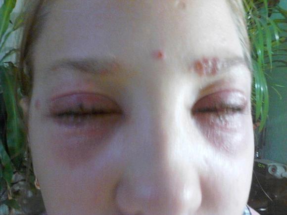 nữ sinh 13 tuổi suýt bị mù vì nhuộm mi, Masha Kuznetsova nhuộm mi, Masha Kuznetsova bỏng hóa chất