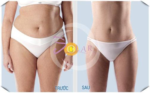 Solar spa, Giảm mỡ bụng, Giảm mỡ bụng công nghệ cao, Giảm mỡ bụng không phẫu thuật
