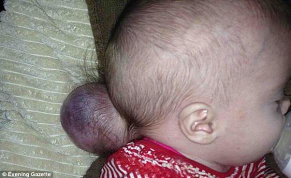 thoát vị não,sống sót khi não tràn khỏi hộp sọ
