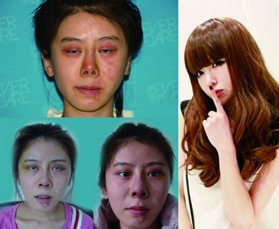 phẫu thuật thẩm mĩ,nghiện phẫu thuật thẩm mỹ