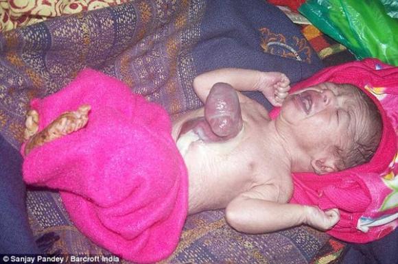Cơ thể kỳ lạ,căn bệnh hiếm gặp,em bé,Ấn Độ,chào đời.