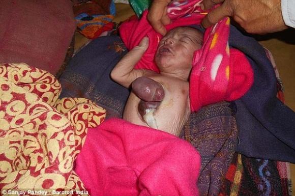 Cơ thể kỳ lạ,căn bệnh hiếm gặp,em bé,Ấn Độ,chào đời.