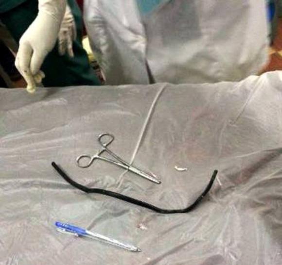 Chuyện lạ,nuốt dây điện,2 năm,trong bụng,Nghệ An,nhập viện.