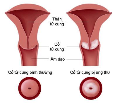 ung thư cổ tử cung,nguy cơ mắc bệnh ung thư