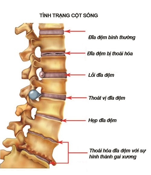 Bệnh gai cột sống,biến chứng của bệnh gai cột sống,nguyên tắc chữa trị và phòng bệnh
