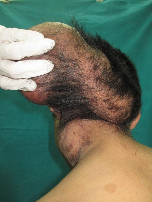 Khối u,cắt khối u khổng lồ cho người hai đầu,khối u nặng 15kg