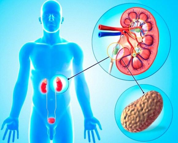 Sỏi thận,Nhiệt độ cao,Biến đổi môi trường