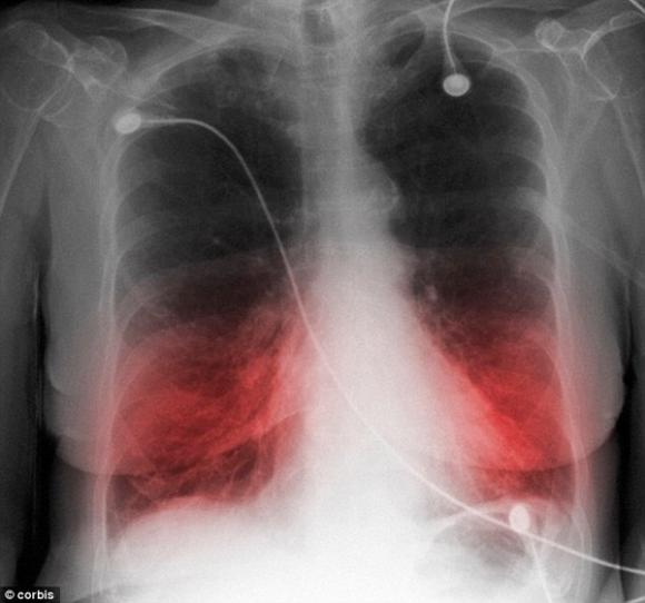 béo bụng,tác hại của béo bụng,bệnh từ béo bụng