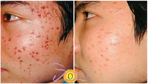 Solar Spa, Trị mụn, Điều trị mụn công nghệ cao