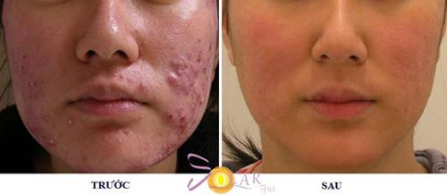 Solar Spa, Trị mụn, Điều trị mụn công nghệ cao