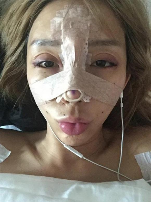 Leng Yein thẩm mỹ, mẫu nữ Malaysia thẩm mỹ, Leng Yein công khai ảnh phẫu thuật
