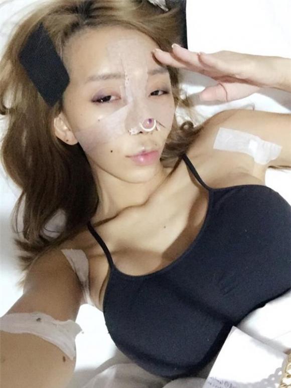 Leng Yein thẩm mỹ, mẫu nữ Malaysia thẩm mỹ, Leng Yein công khai ảnh phẫu thuật