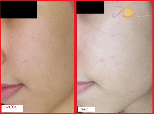 Solar Spa, Tắm trắng, Làm trắng da, Dưỡng trắng da