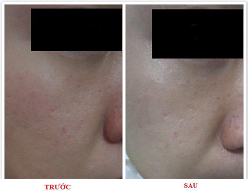 Solar Spa, Tắm trắng, Làm trắng da, Dưỡng trắng da