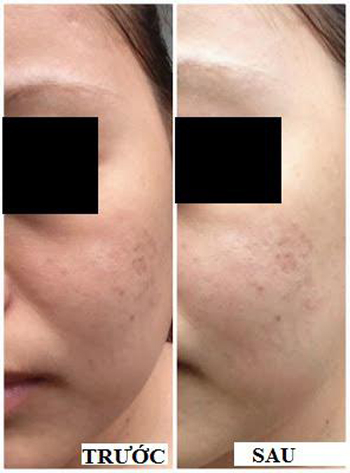 Solar Spa, Tắm trắng, Làm trắng da, Dưỡng trắng da