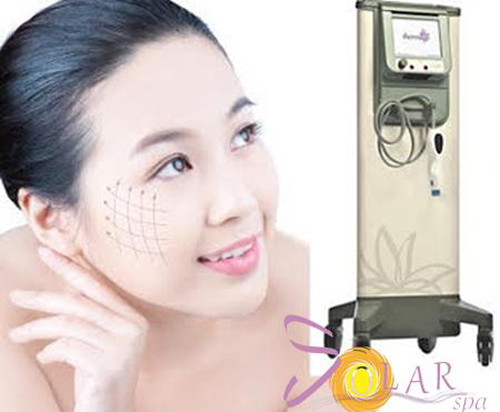 Solar Spa, Căng da mặt, Căng da mặt không phẫu thuật