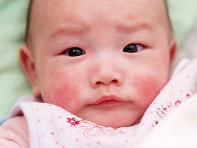 dị ứng, viêm da cơ địa, dị ứng theo mùa,cách chữa dị ứng cho trẻ nhỏ