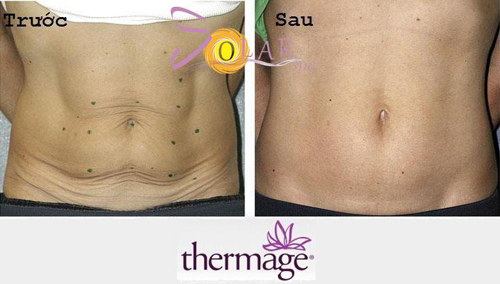 Trị sạm da, Lão hóa da, Solar spa