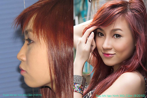 Mỹ viện Hồng Hạnh, Thẩm mỹ viện uy tín, Thẩm mỹ viện nâng mũi, Nâng mũi