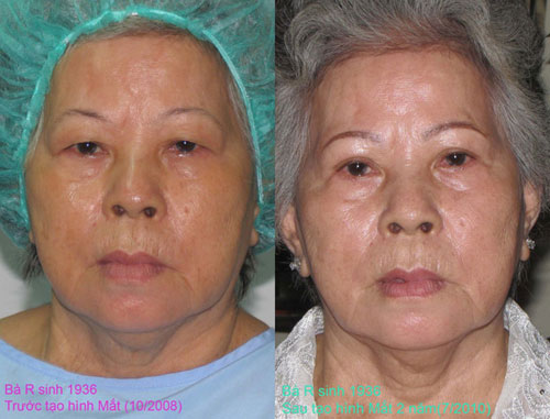 Mỹ viện Hồng Hạnh, Thẩm mỹ viện uy tín, Thẩm mỹ viện nâng mũi, Nâng mũi