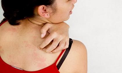 mề đay, rau kinh giới, chữa mẩn ngứa, chữa bệnh ngứa
