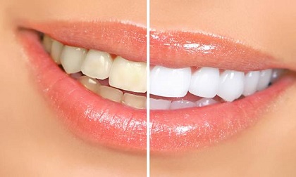 mảng bám răng, loại bỏ mảng bám răng, dầu dừa giúp đánh bật mảng bám răng