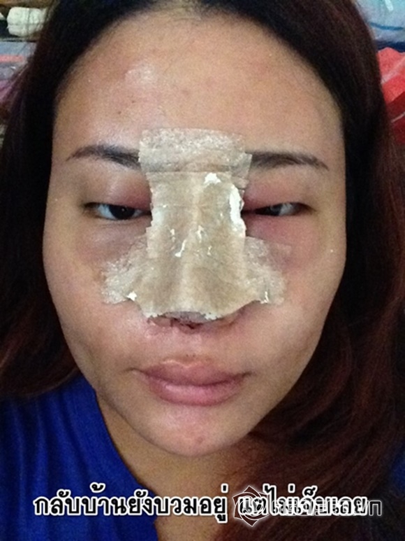 cô gái lột xác nhờ thẩm mỹ mũi, cô gái nổi tiếng trong giới trẻ Thái Lan