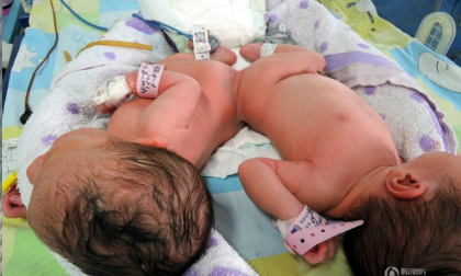 2 bé song sinh dính liền, phẫu thuật, tách rời 2 bé song sinh