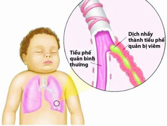 trẻ bị bênh, chăm trẻ, phòng bệnh cho trẻ, trẻ bị cảm nắng, trẻ bị sốt, chăm con, sổ mũi, cảm cúm