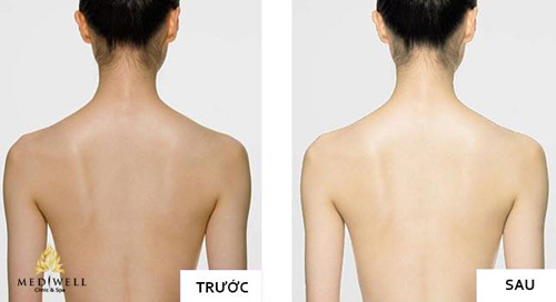 lieu-phap-trang-da84-2-ngoisao 0 Tắm trắng, Tắm trắng bằng tế bào phôi Organo, Mediwell Spa