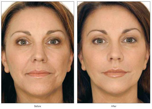 bb-beauty-bb-thanh-mai-174-6-ngoisao 0 Trẻ hóa da, Trẻ hóa toàn diện, BB Beauté – BB Thanh Mai, Thẩm mỹ viện trẻ hóa da