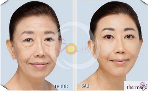 solar-spa-184-2-ngoisao 1 Solar Spa, Solar Spa khuyến mại, Căn da mặt, Căng da mặt không phẫu thuật