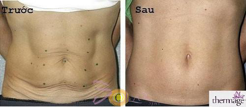 solar-spa-184-3-ngoisao 0 Solar Spa, Solar Spa khuyến mại, Căn da mặt, Căng da mặt không phẫu thuật