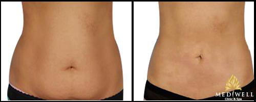 mediwell-spa-224-2-ngoisao 0 mediwell spa, Hủy mỡ công nghệ cao, Hủy mỡ thừa