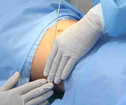 giam-beo-234-2-ngoisao 0 Giảm béo, Giảm mỡ bụng, Mediwell spa, Giảm béo 1 lần duy nhất