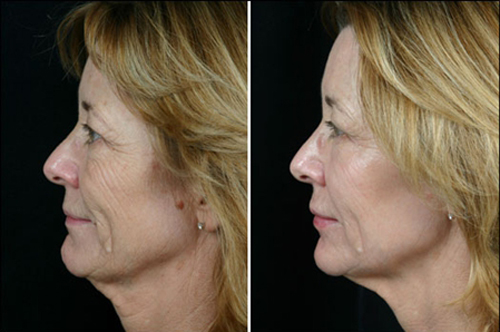 song-cao-tan-45-3-ngoisao 6 Trẻ hóa da, Chăm sóc da, Phục hồi da lão hóa, Trẻ hóa da bằng sóng cao tần, BB Thanh Mai