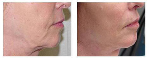 song-cao-tan-45-4-ngoisao 5 Trẻ hóa da, Chăm sóc da, Phục hồi da lão hóa, Trẻ hóa da bằng sóng cao tần, BB Thanh Mai