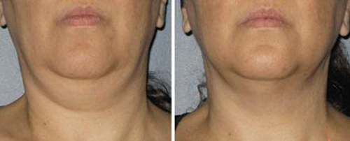 song-cao-tan-45-5-ngoisao 4 Trẻ hóa da, Chăm sóc da, Phục hồi da lão hóa, Trẻ hóa da bằng sóng cao tần, BB Thanh Mai