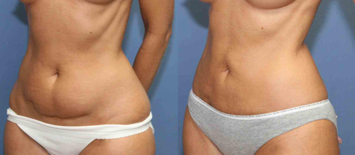 Giảm béo, Giảm mỡ bụng, Mediwell spa, Giảm béo trong khi ngủ