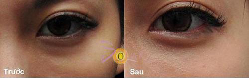 solar-spa-115-2-ngoisao 2 Xóa quầng thâm mắt, Solar spa, đánh tan bọng mỡ