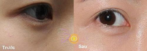 solar-spa-115-3-ngoisao 1 Xóa quầng thâm mắt, Solar spa, đánh tan bọng mỡ