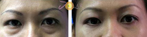 solar-spa-115-4-ngoisao 0 Xóa quầng thâm mắt, Solar spa, đánh tan bọng mỡ