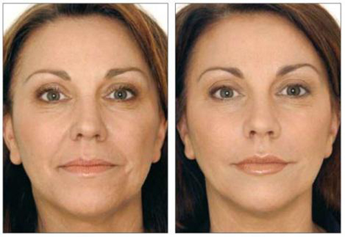 Trẻ hóa da, Trẻ hóa 1 lần duy nhất, Trẻ hóa da không phẫu thuật, Mediwell spa