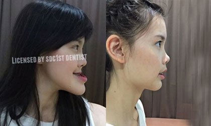 cô gái trẻ Thái Lan,chỉnh sửa mũi đau đớn,cô gái trẻ Thái Lan chỉnh sửa mũi,chỉnh sửa mũi cho thon gọn,chỉnh sửa mũi cho thanh thoát,cô gái trẻ Thái Lan phẫu thuật chỉnh sửa mũi