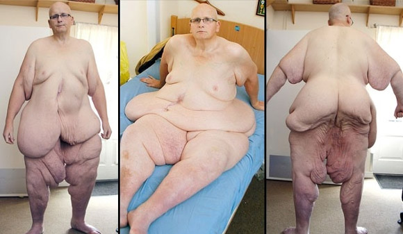 Paul Mason,người đàn ông từng béo nhất thế giới,người đàn ông béo phẫu thuật da